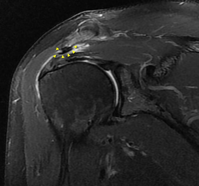 어깨충돌증후군 MRI 사진