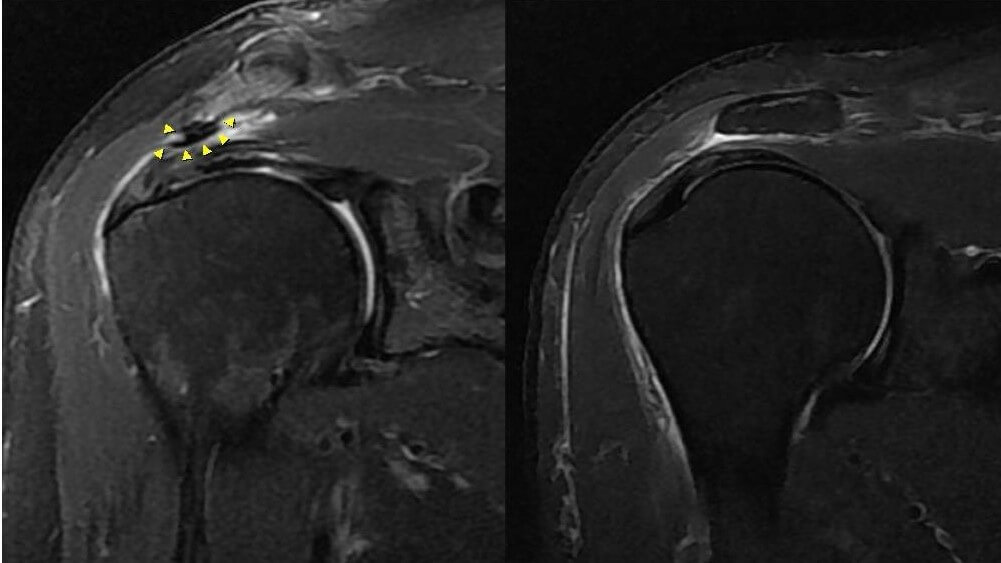 어깨충돌증후군 관절경 수술 전후 MRI 사진 비교
