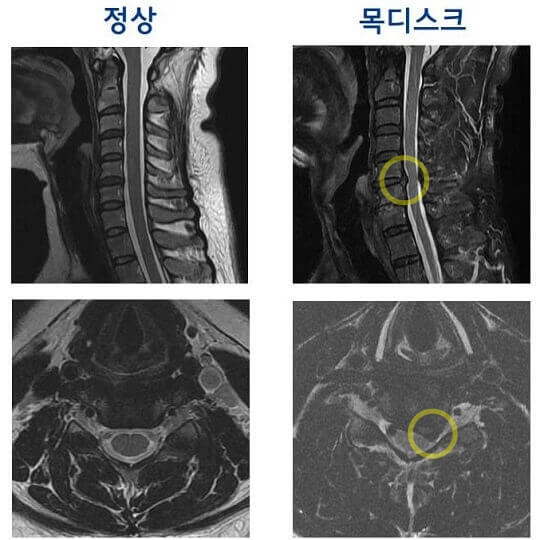 정상 MRI 사진과 목디스크 MRI 사진 비교