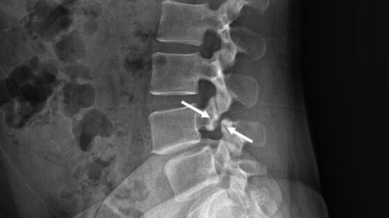 척추분리증 측면 x-ray 사진