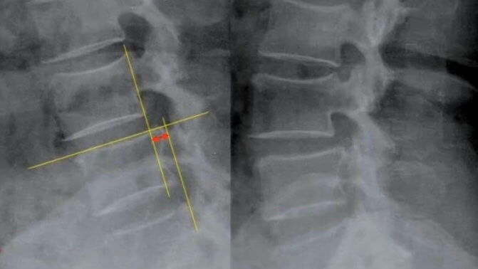 척추불안정증 측면 x-ray 사진