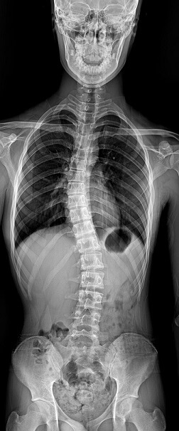 척추측만증 정면 x-ray 사진