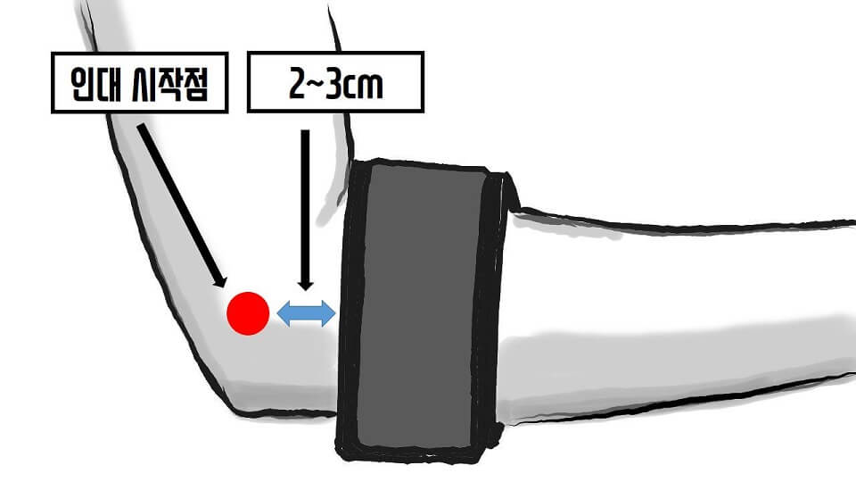 외상과염, 요골신경 이용한 테니스 팔꿈치 증상 치료 6