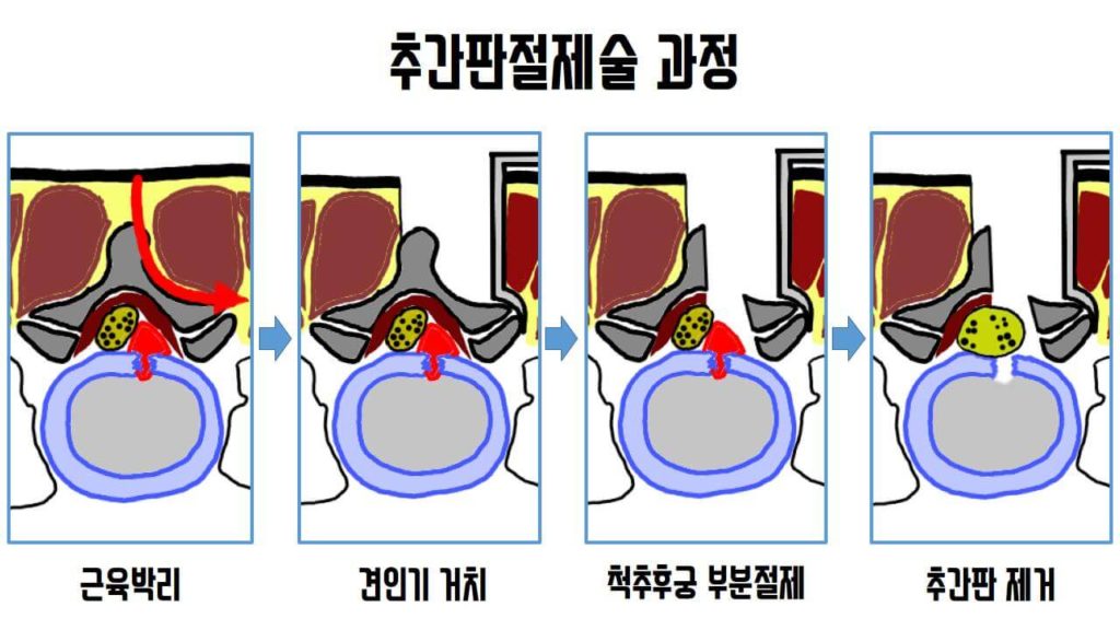 미세현미경 추간판제거술