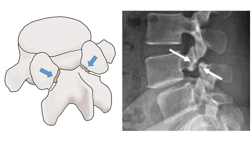 척추분리증 모형도와 x-ray 사진