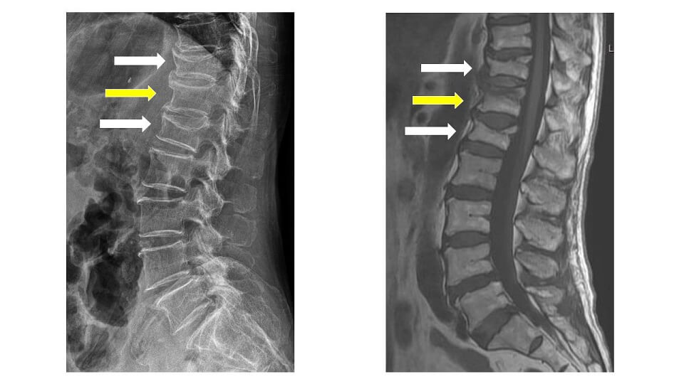 척추압박골절 X-ray와 MRI 사진 비교