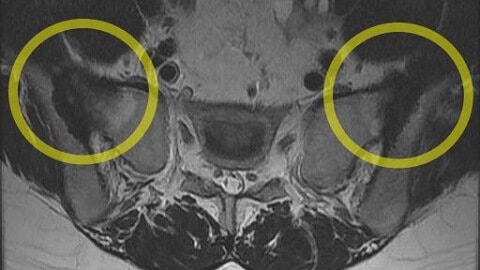 천장관절염 MRI 사진