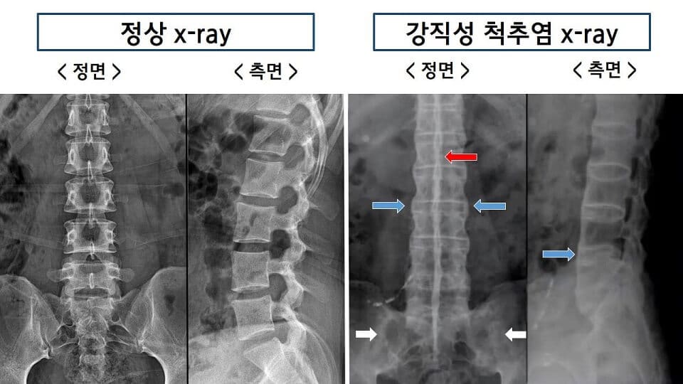 강직성 척추염 x-ray: 대나무 척추(bamboo spine) 소견