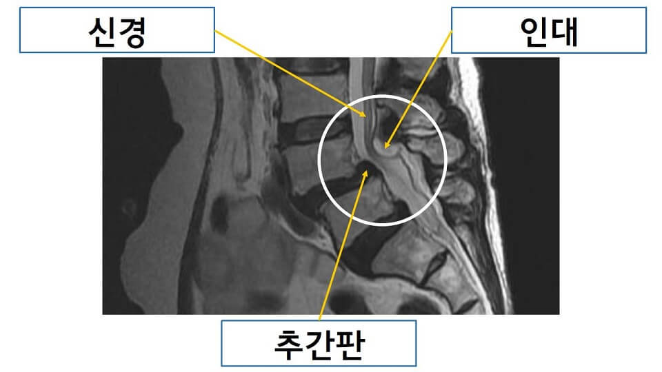 척추전방전위증 MRI
