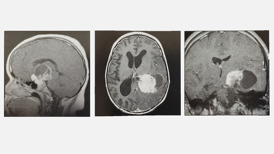 여러가지 뇌종양 MRI 사진들 : 뇌종양 증상은 뇌종양 종류, 위치에 따라 다양하다.