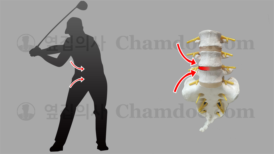 골프 다운스윙이 척추와 허리디스크(추간판)에 미치는 영향
