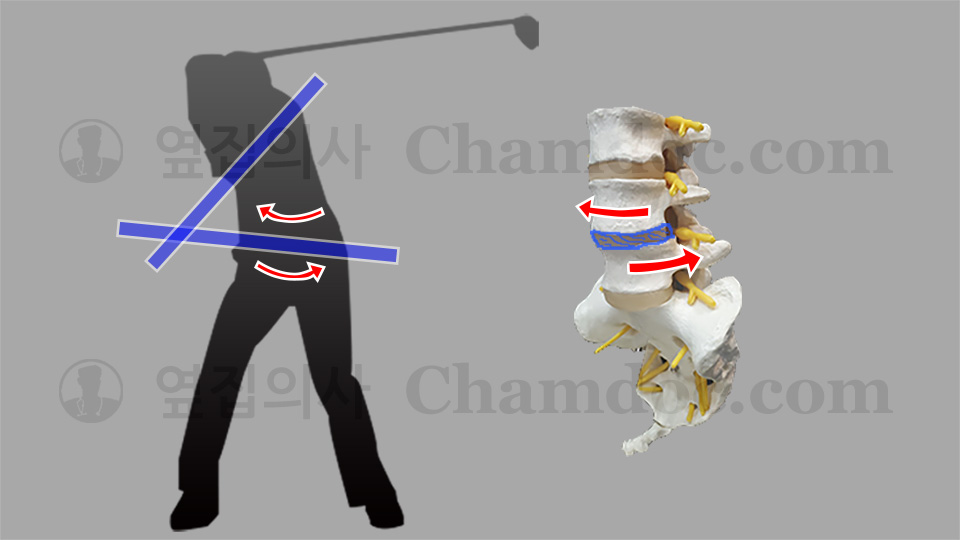 골프 백스윙이 척추와 허리디스크(추간판)에 미치는 영향